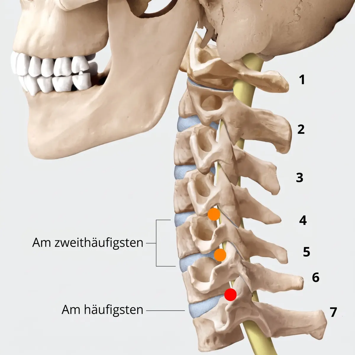 Medizinische 3D-Darstellung der Halswirbelsäule von C1 bis C7 mit gelb markiertem Nervenverlauf; markierte Bandscheibenbereiche zwischen den Wirbeln 4 bis 7